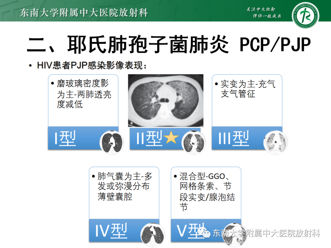 影像PPT - 【PPT】蝶翼征—耶氏肺孢子菌肺炎 VS 急性心源性肺水肿-21 影像PPT - 【PPT】蝶翼征—耶氏肺孢子菌肺炎 VS 急性心源性肺水肿-21