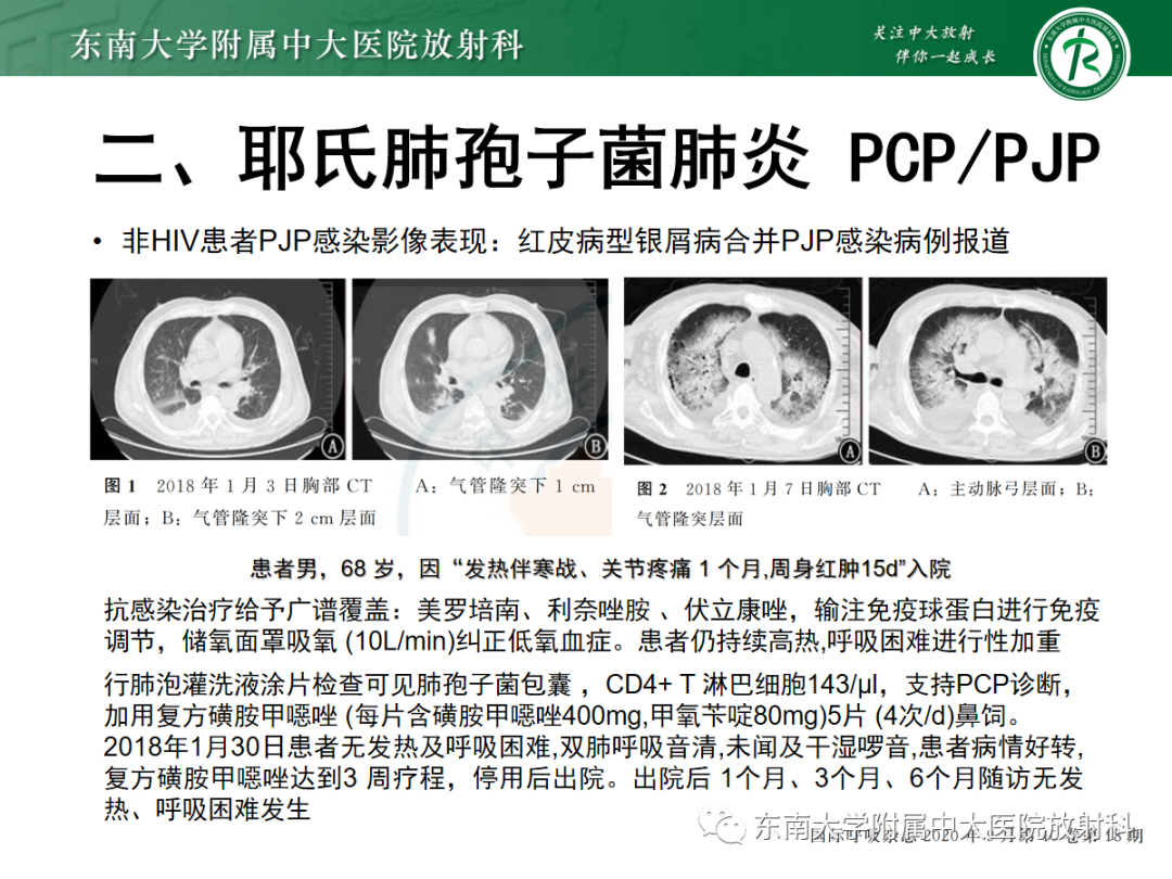 影像PPT - 【PPT】蝶翼征—耶氏肺孢子菌肺炎 VS 急性心源性肺水肿-23 影像PPT - 【PPT】蝶翼征—耶氏肺孢子菌肺炎 VS 急性心源性肺水肿-23