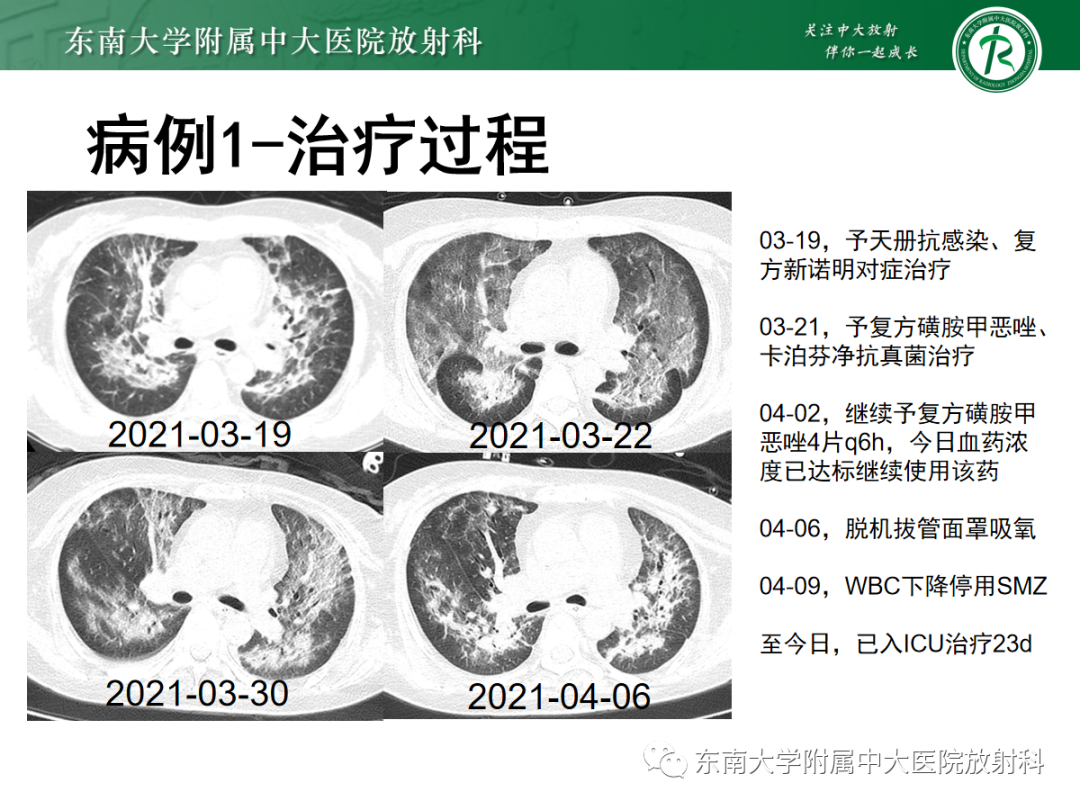 影像PPT - 【PPT】蝶翼征—耶氏肺孢子菌肺炎 VS 急性心源性肺水肿-24 影像PPT - 【PPT】蝶翼征—耶氏肺孢子菌肺炎 VS 急性心源性肺水肿-24