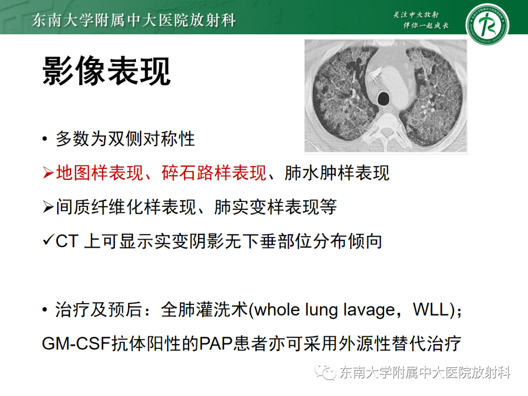 影像PPT - 【PPT】蝶翼征—耶氏肺孢子菌肺炎 VS 急性心源性肺水肿-29 影像PPT - 【PPT】蝶翼征—耶氏肺孢子菌肺炎 VS 急性心源性肺水肿-29