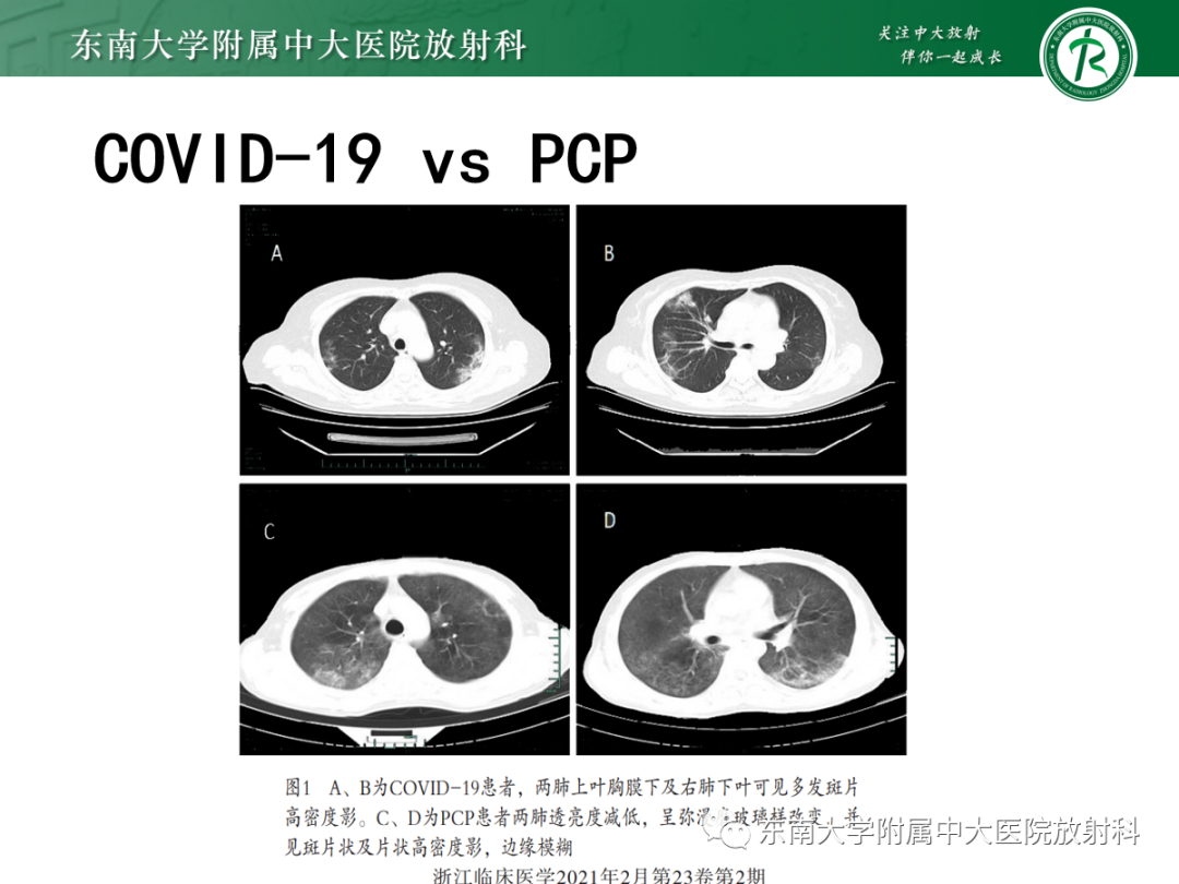 影像PPT - 【PPT】蝶翼征—耶氏肺孢子菌肺炎 VS 急性心源性肺水肿-27 影像PPT - 【PPT】蝶翼征—耶氏肺孢子菌肺炎 VS 急性心源性肺水肿-27