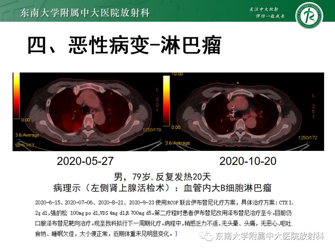 影像PPT - 【PPT】蝶翼征—耶氏肺孢子菌肺炎 VS 急性心源性肺水肿-30 影像PPT - 【PPT】蝶翼征—耶氏肺孢子菌肺炎 VS 急性心源性肺水肿-30