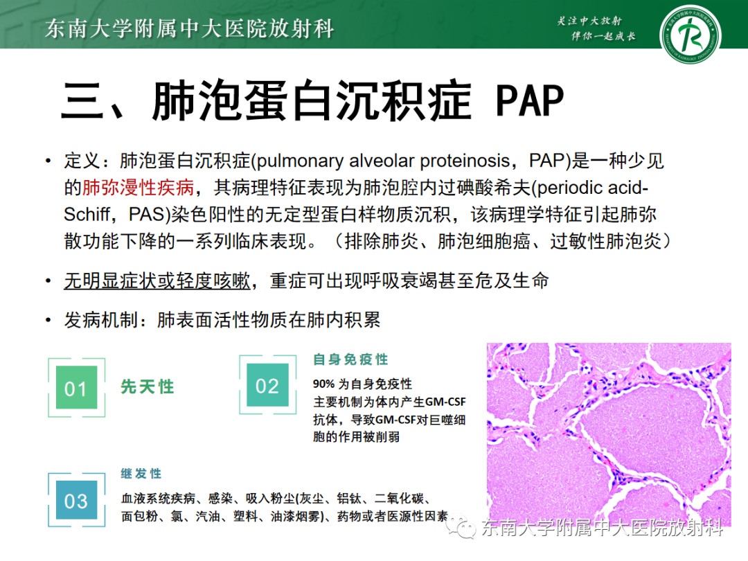 影像PPT - 【PPT】蝶翼征—耶氏肺孢子菌肺炎 VS 急性心源性肺水肿-28 影像PPT - 【PPT】蝶翼征—耶氏肺孢子菌肺炎 VS 急性心源性肺水肿-28