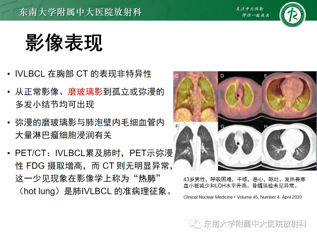 影像PPT - 【PPT】蝶翼征—耶氏肺孢子菌肺炎 VS 急性心源性肺水肿-33 影像PPT - 【PPT】蝶翼征—耶氏肺孢子菌肺炎 VS 急性心源性肺水肿-33