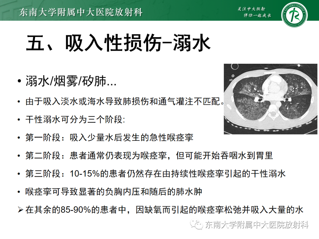 影像PPT - 【PPT】蝶翼征—耶氏肺孢子菌肺炎 VS 急性心源性肺水肿-34 影像PPT - 【PPT】蝶翼征—耶氏肺孢子菌肺炎 VS 急性心源性肺水肿-34