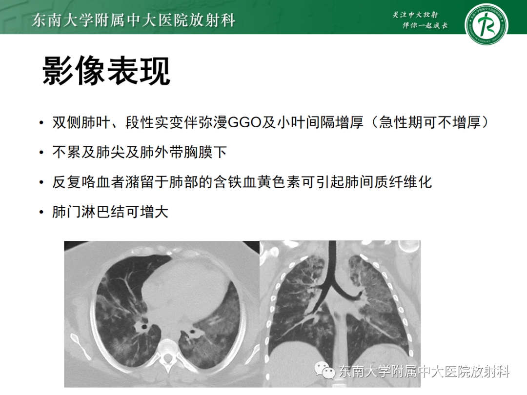 影像PPT - 【PPT】蝶翼征—耶氏肺孢子菌肺炎 VS 急性心源性肺水肿-36 影像PPT - 【PPT】蝶翼征—耶氏肺孢子菌肺炎 VS 急性心源性肺水肿-36