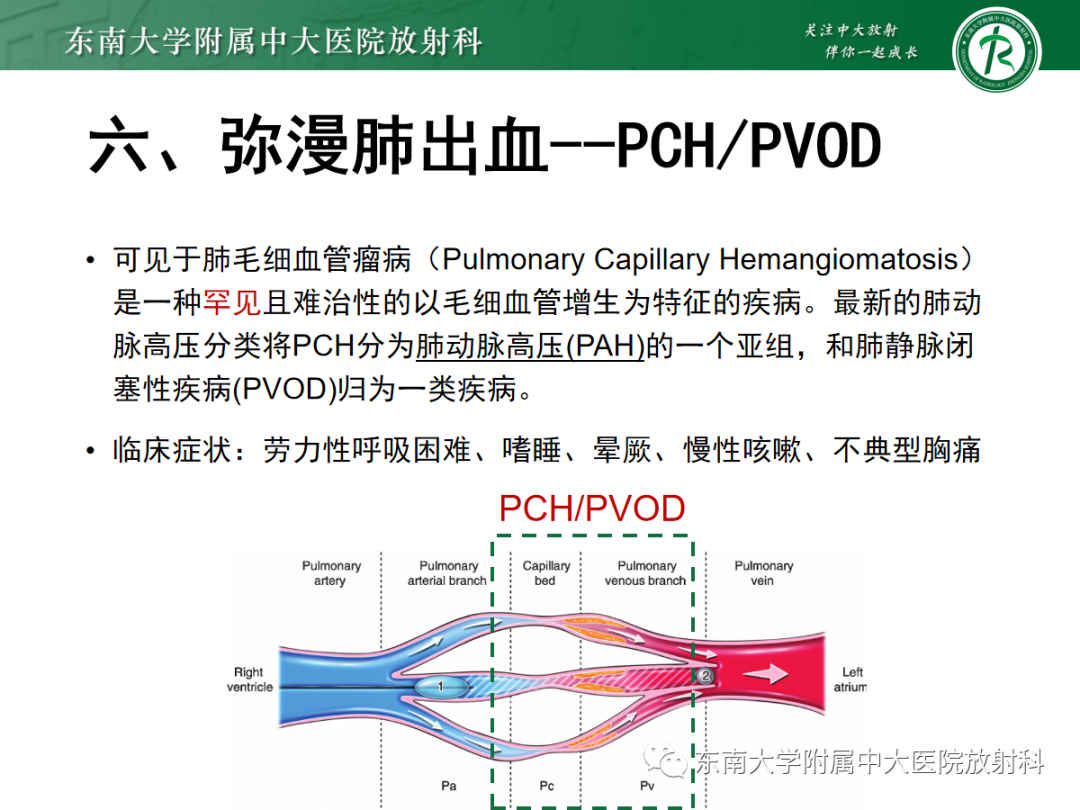 影像PPT - 【PPT】蝶翼征—耶氏肺孢子菌肺炎 VS 急性心源性肺水肿-37 影像PPT - 【PPT】蝶翼征—耶氏肺孢子菌肺炎 VS 急性心源性肺水肿-37