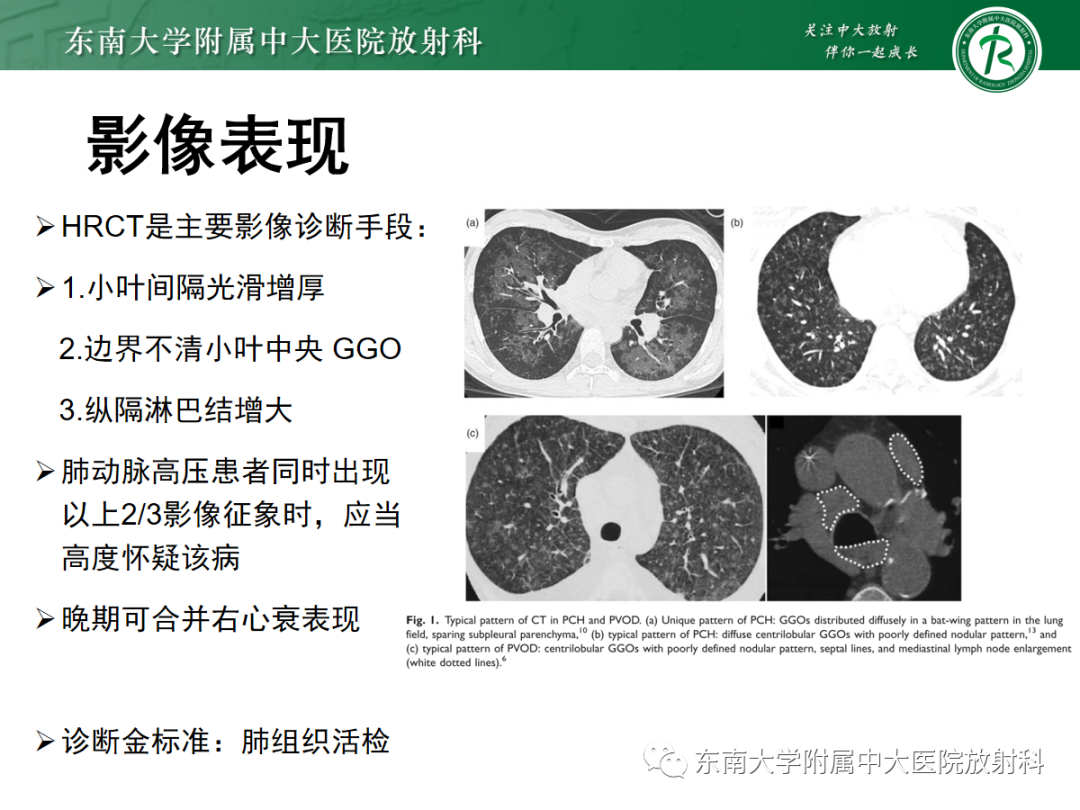 影像PPT - 【PPT】蝶翼征—耶氏肺孢子菌肺炎 VS 急性心源性肺水肿-39 影像PPT - 【PPT】蝶翼征—耶氏肺孢子菌肺炎 VS 急性心源性肺水肿-39