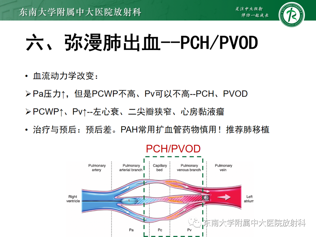 影像PPT - 【PPT】蝶翼征—耶氏肺孢子菌肺炎 VS 急性心源性肺水肿-38 影像PPT - 【PPT】蝶翼征—耶氏肺孢子菌肺炎 VS 急性心源性肺水肿-38