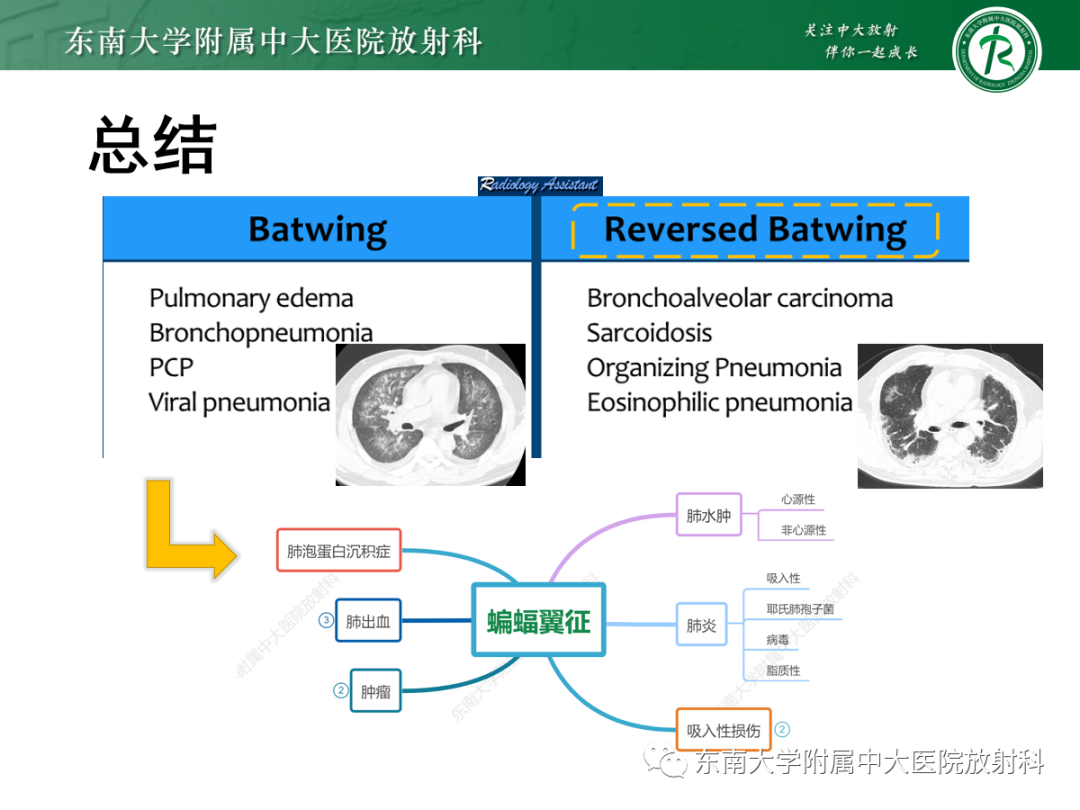 影像PPT - 【PPT】蝶翼征—耶氏肺孢子菌肺炎 VS 急性心源性肺水肿-40 影像PPT - 【PPT】蝶翼征—耶氏肺孢子菌肺炎 VS 急性心源性肺水肿-40