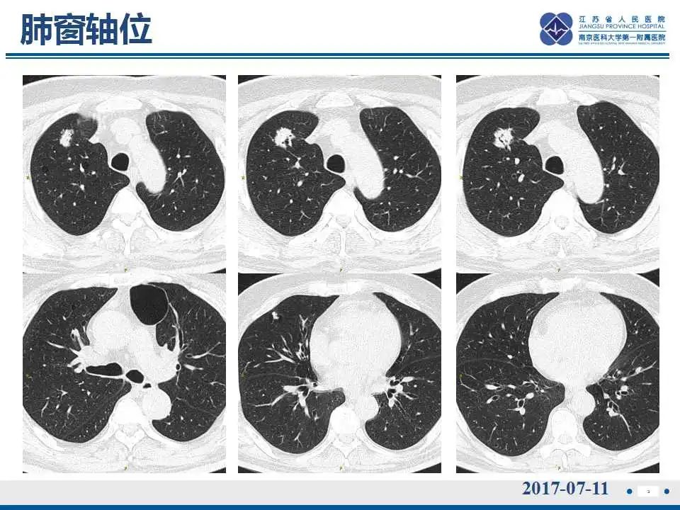 影像PPT - 【PPT】肺淀粉样变性伴粘膜相关淋巴组织淋巴瘤-4