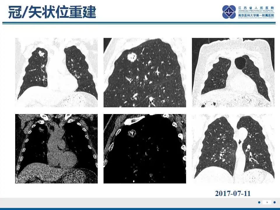 影像PPT - 【PPT】肺淀粉样变性伴粘膜相关淋巴组织淋巴瘤-6