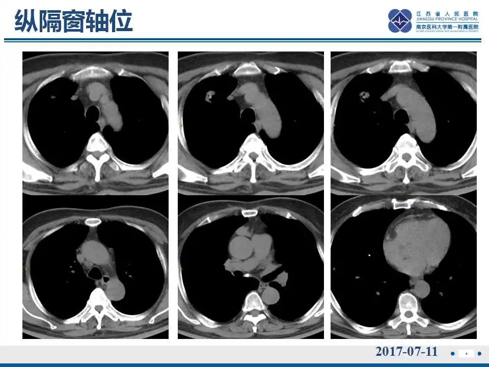 影像PPT - 【PPT】肺淀粉样变性伴粘膜相关淋巴组织淋巴瘤-5