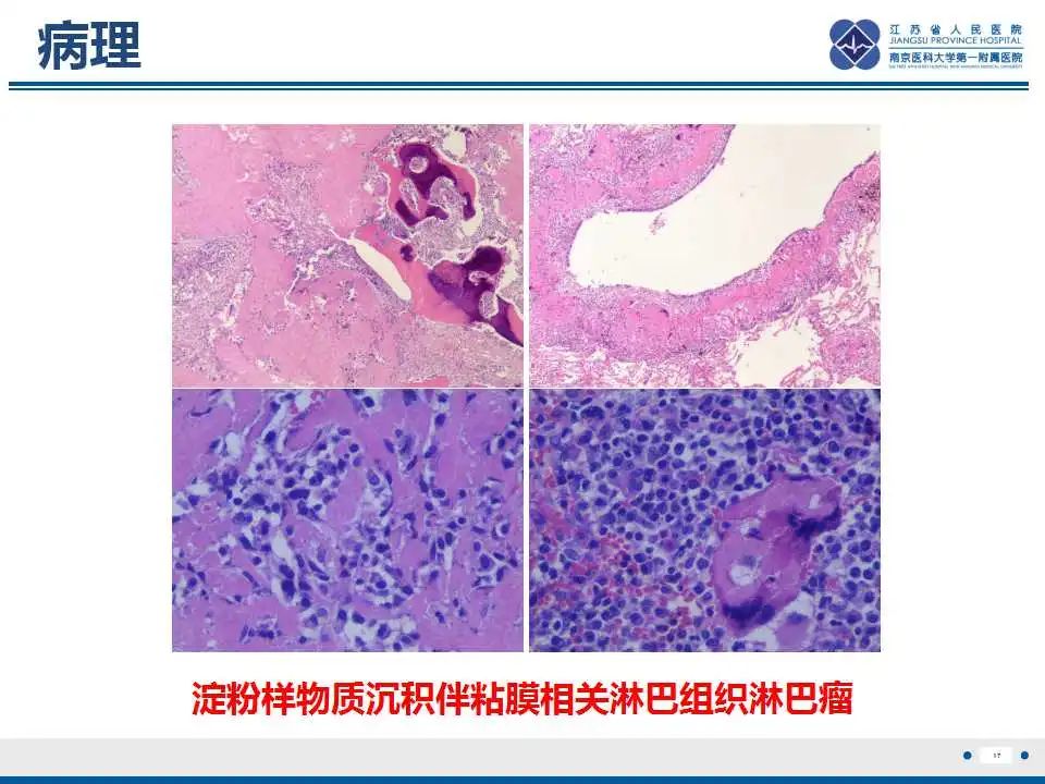 影像PPT - 【PPT】肺淀粉样变性伴粘膜相关淋巴组织淋巴瘤-18
