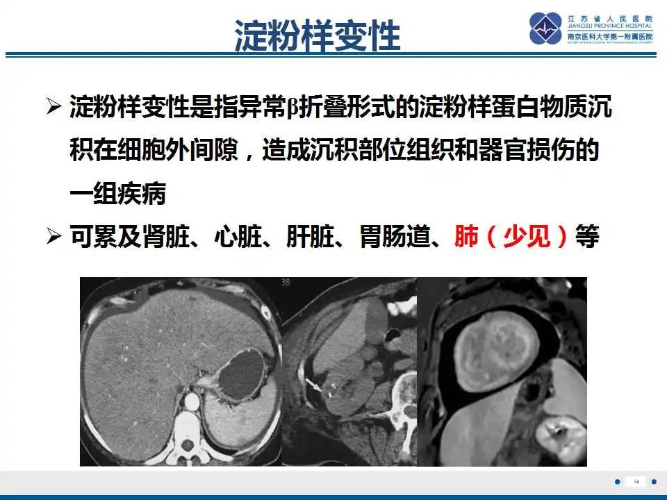 影像PPT - 【PPT】肺淀粉样变性伴粘膜相关淋巴组织淋巴瘤-20