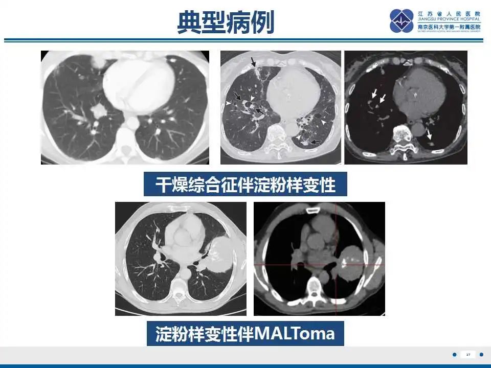 影像PPT - 【PPT】肺淀粉样变性伴粘膜相关淋巴组织淋巴瘤-29