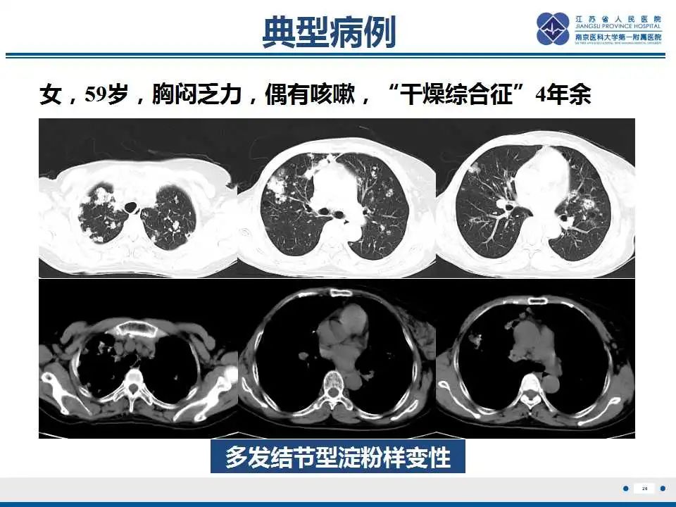 影像PPT - 【PPT】肺淀粉样变性伴粘膜相关淋巴组织淋巴瘤-28