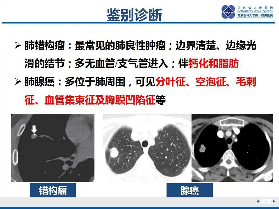 影像PPT - 【PPT】肺淀粉样变性伴粘膜相关淋巴组织淋巴瘤-32