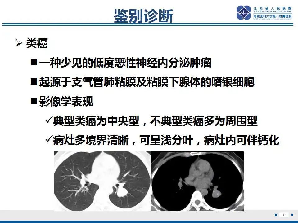 影像PPT - 【PPT】肺淀粉样变性伴粘膜相关淋巴组织淋巴瘤-33