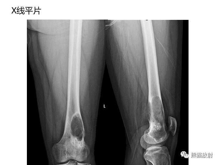 影像PPT - 【病例】骨肉瘤2例X线CT及MR影像-3