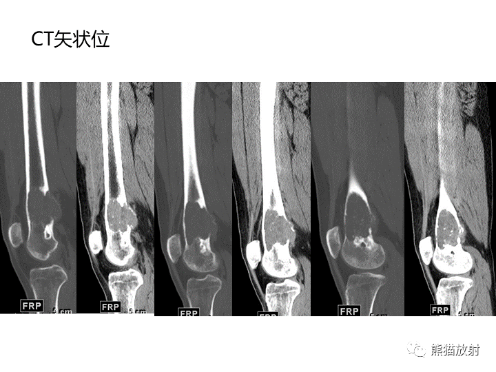 影像PPT - 【病例】骨肉瘤2例X线CT及MR影像-5