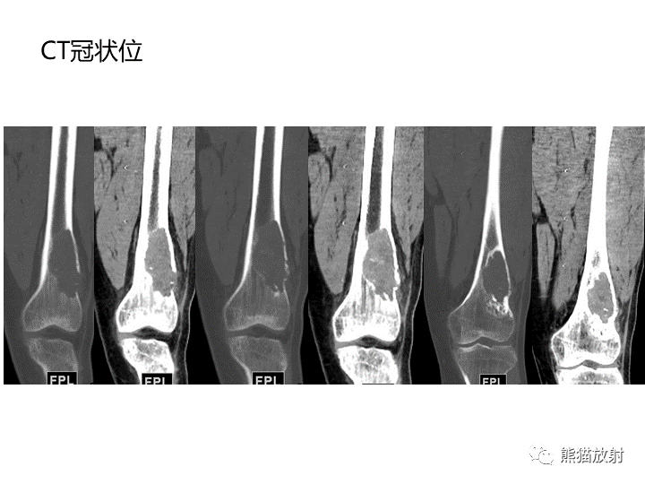 影像PPT - 【病例】骨肉瘤2例X线CT及MR影像-4