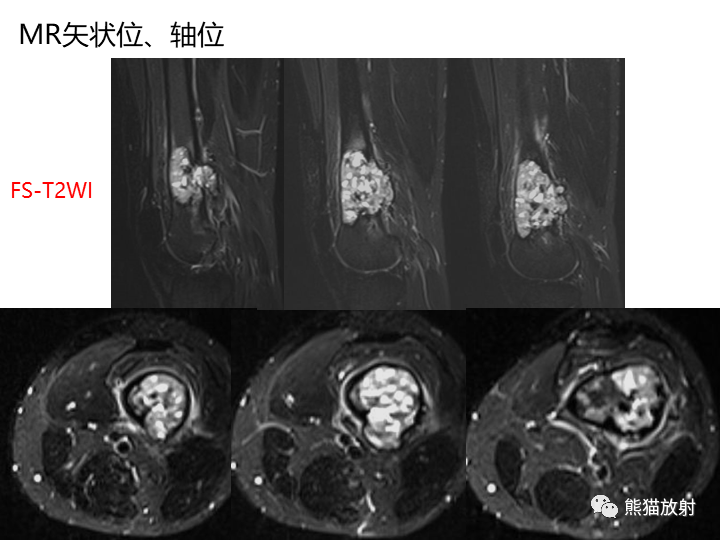 影像PPT - 【病例】骨肉瘤2例X线CT及MR影像-8