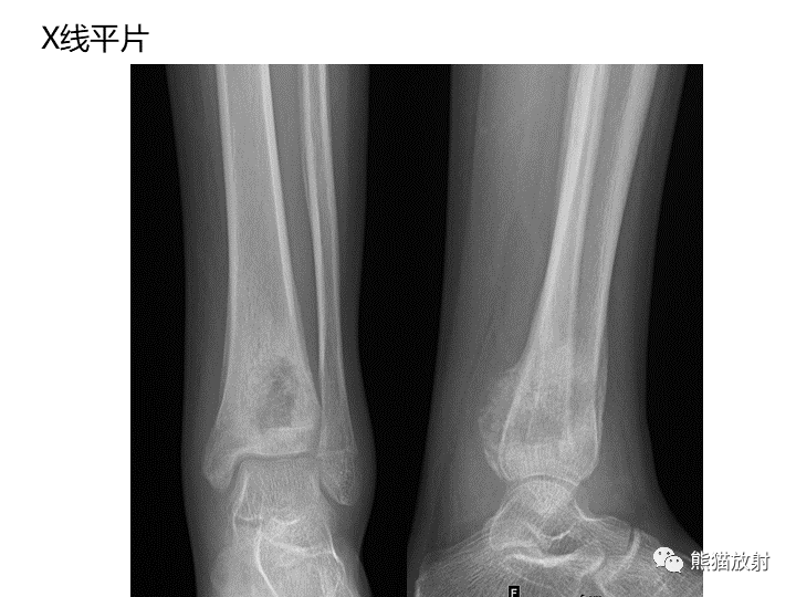 影像PPT - 【病例】骨肉瘤2例X线CT及MR影像-15