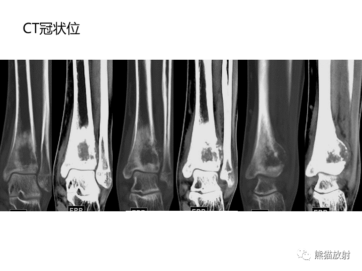 影像PPT - 【病例】骨肉瘤2例X线CT及MR影像-16