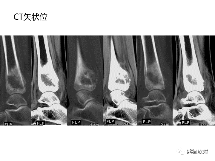 影像PPT - 【病例】骨肉瘤2例X线CT及MR影像-17