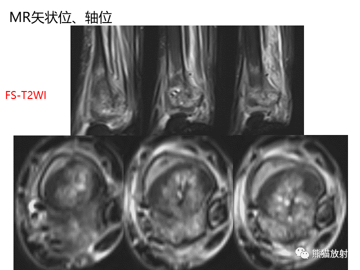 影像PPT - 【病例】骨肉瘤2例X线CT及MR影像-20