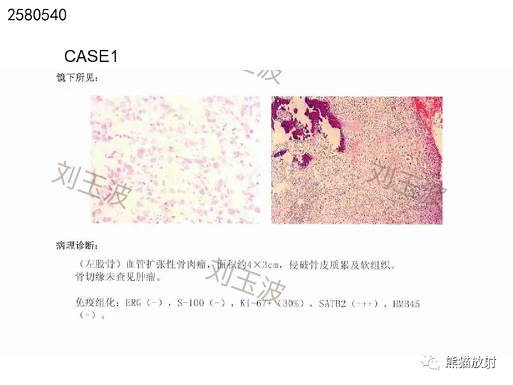 影像PPT - 【病例】骨肉瘤2例X线CT及MR影像-23