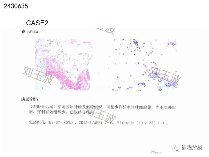 影像PPT - 【病例】骨肉瘤2例X线CT及MR影像-24