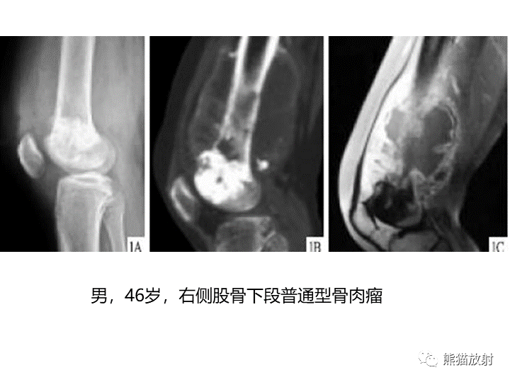 影像PPT - 【病例】骨肉瘤2例X线CT及MR影像-28