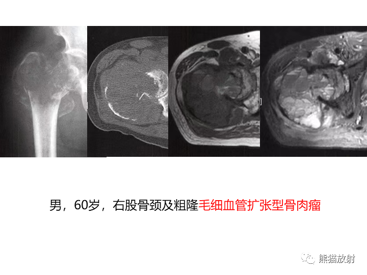 影像PPT - 【病例】骨肉瘤2例X线CT及MR影像-30