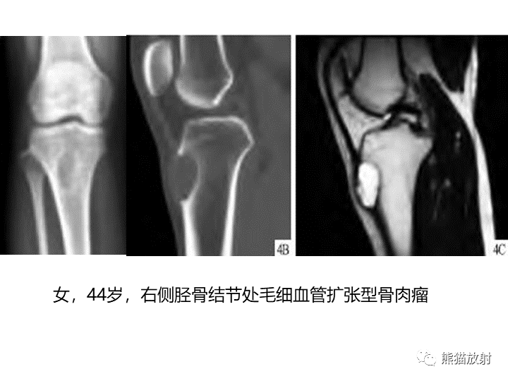 影像PPT - 【病例】骨肉瘤2例X线CT及MR影像-31