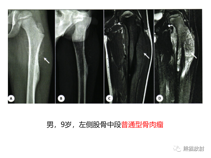 影像PPT - 【病例】骨肉瘤2例X线CT及MR影像-27