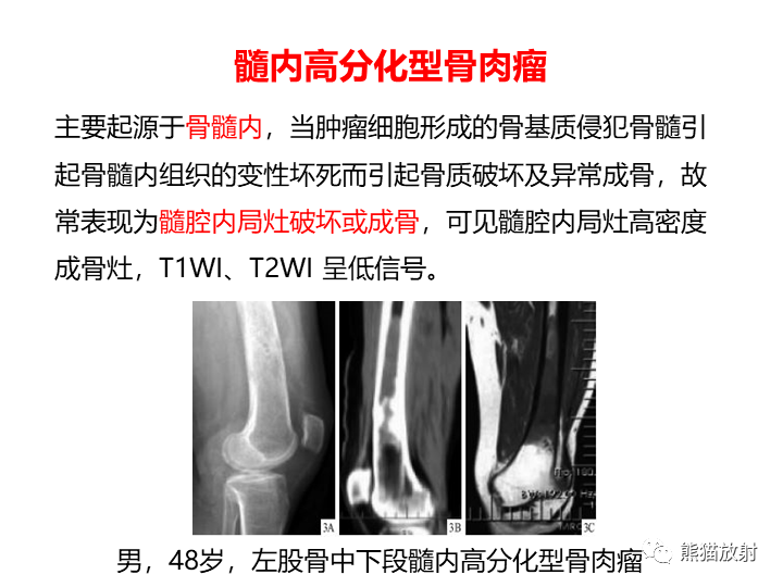 影像PPT - 【病例】骨肉瘤2例X线CT及MR影像-32