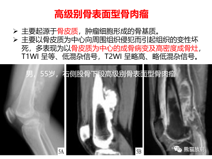 影像PPT - 【病例】骨肉瘤2例X线CT及MR影像-34