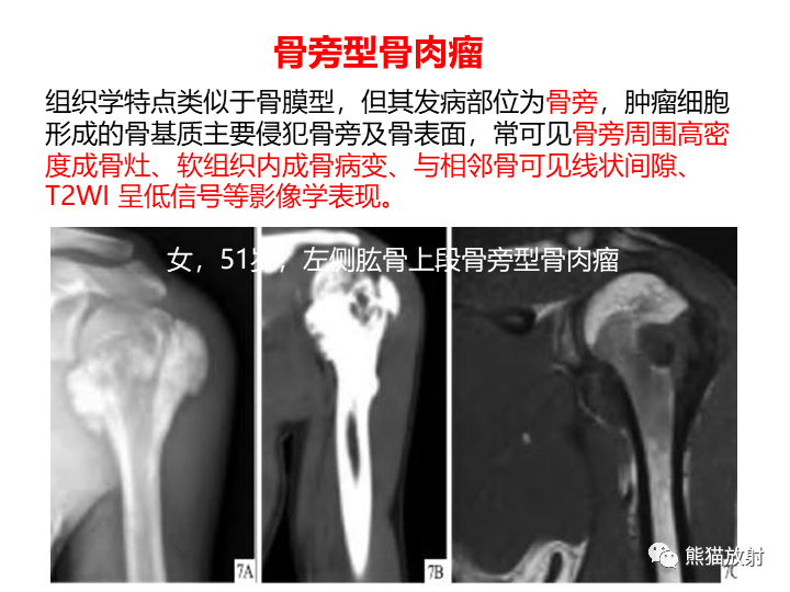 影像PPT - 【病例】骨肉瘤2例X线CT及MR影像-35