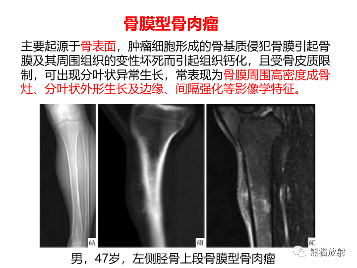 影像PPT - 【病例】骨肉瘤2例X线CT及MR影像-36
