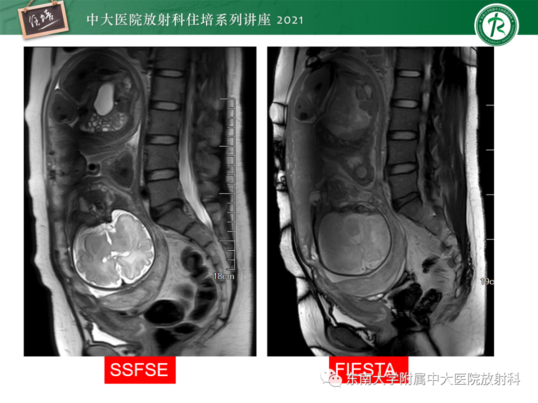 影像PPT - 【PPT】胎盘变异与胎盘植入性疾病的MR评估-6