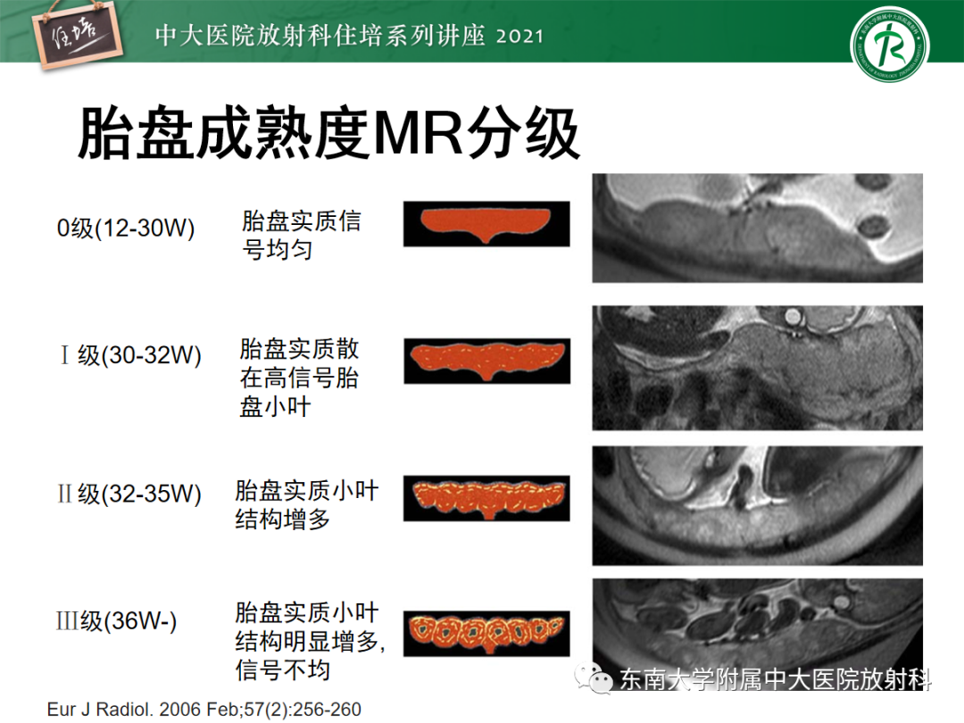 影像PPT - 【PPT】胎盘变异与胎盘植入性疾病的MR评估-8