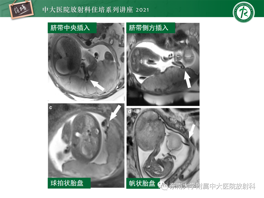 影像PPT - 【PPT】胎盘变异与胎盘植入性疾病的MR评估-10