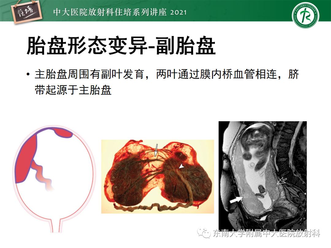 影像PPT - 【PPT】胎盘变异与胎盘植入性疾病的MR评估-11