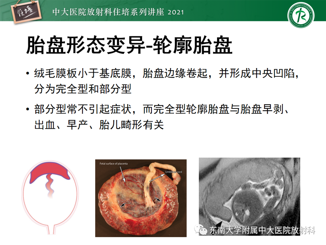影像PPT - 【PPT】胎盘变异与胎盘植入性疾病的MR评估-13