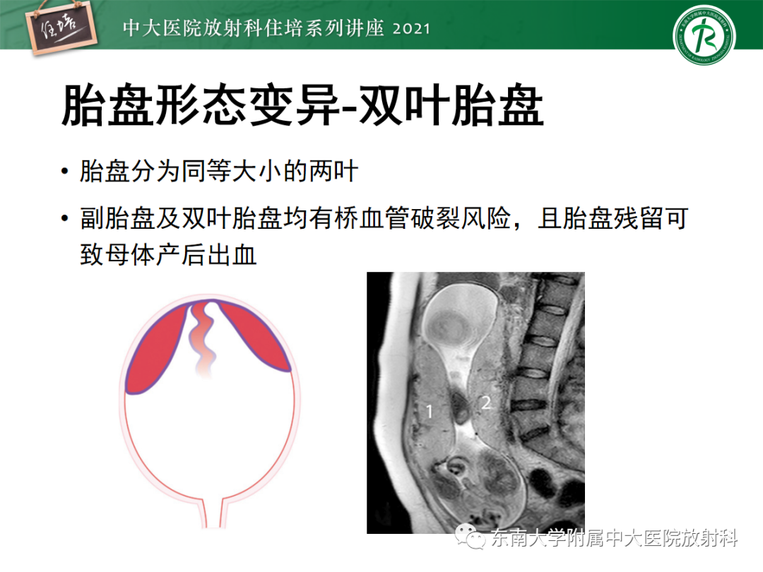 影像PPT - 【PPT】胎盘变异与胎盘植入性疾病的MR评估-12