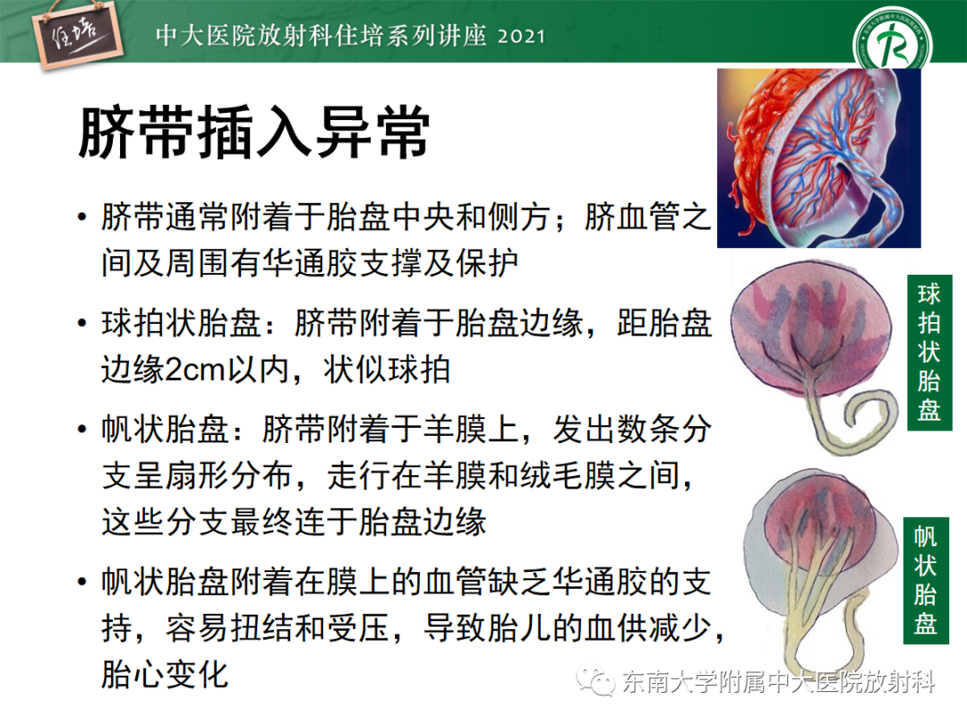 影像PPT - 【PPT】胎盘变异与胎盘植入性疾病的MR评估-9