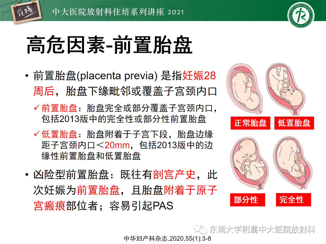 影像PPT - 【PPT】胎盘变异与胎盘植入性疾病的MR评估-17
