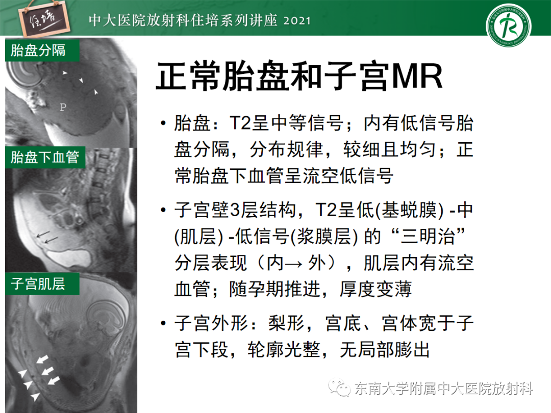 影像PPT - 【PPT】胎盘变异与胎盘植入性疾病的MR评估-20